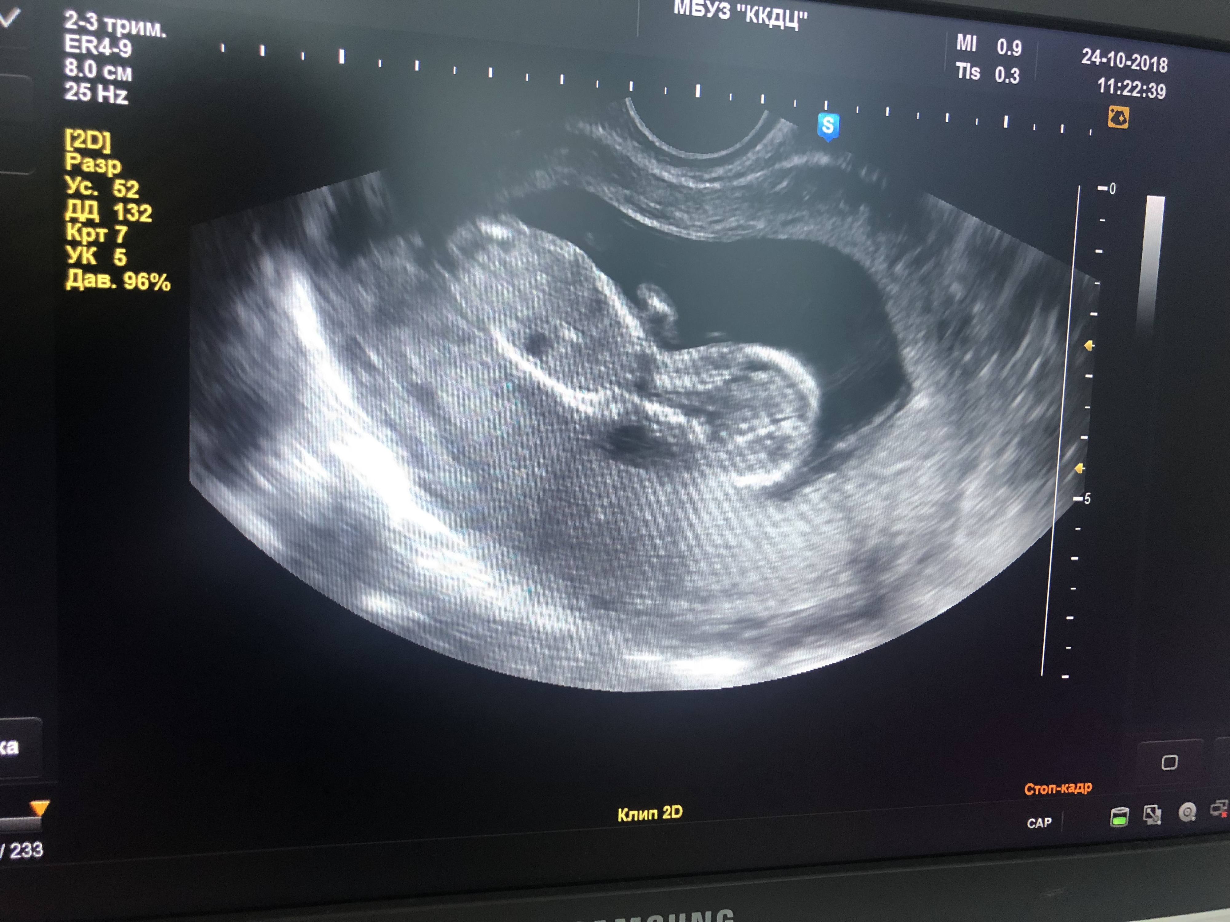 Хочу родить здорового малыша и при этом само остат