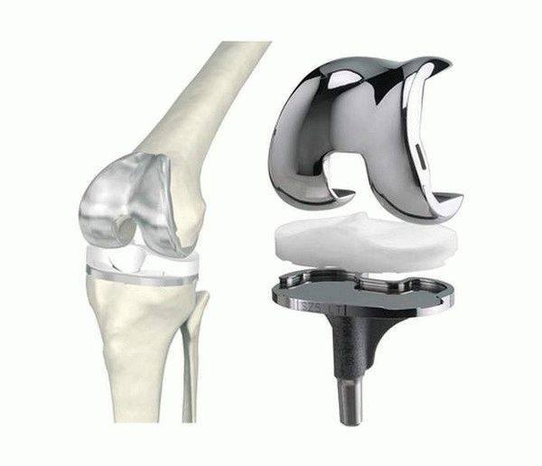 Высокотехнологичный эндопротез коленного сустава