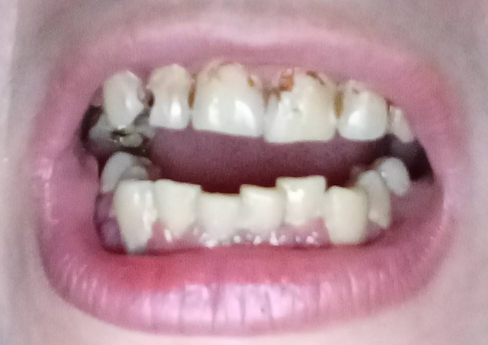 ✍Мечтаю 🥺 просто вылечить зубы🦷.Помогите🙏🙏🙏🙏