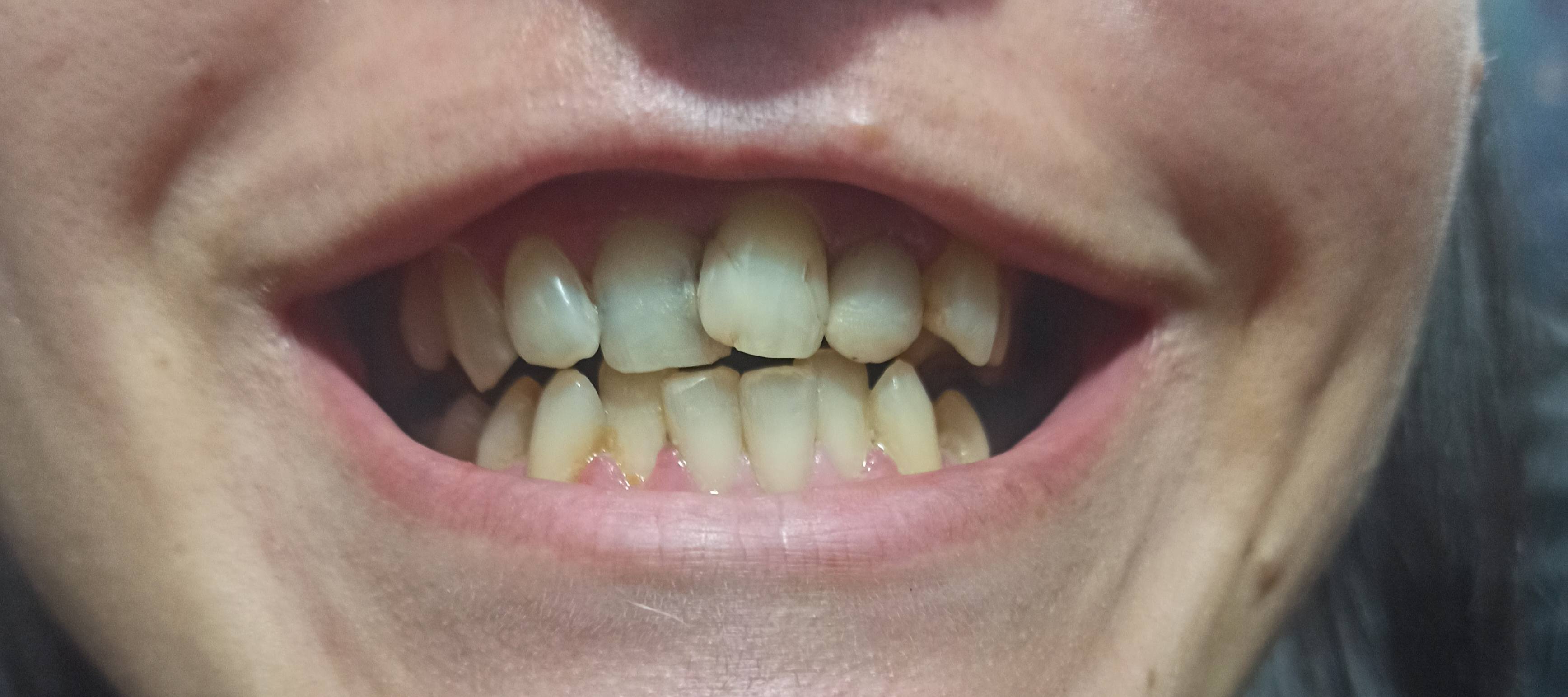 Лечение зубов