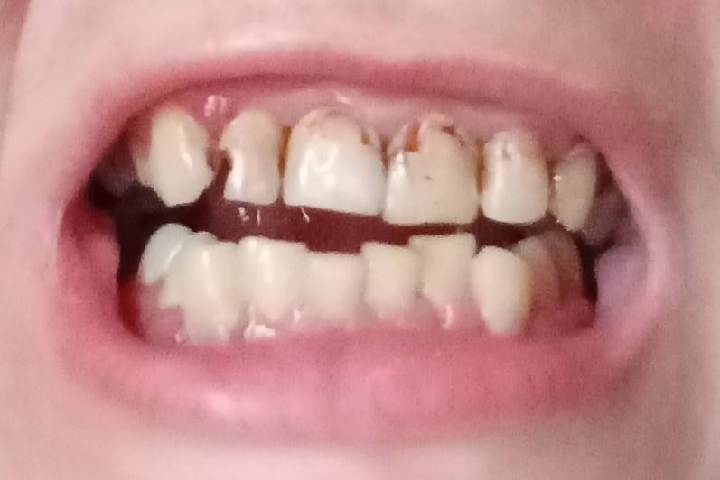 Мечтаю 🥺просто вылечить зубы🦷Нет средств🙏🙏🙏🙏🙏