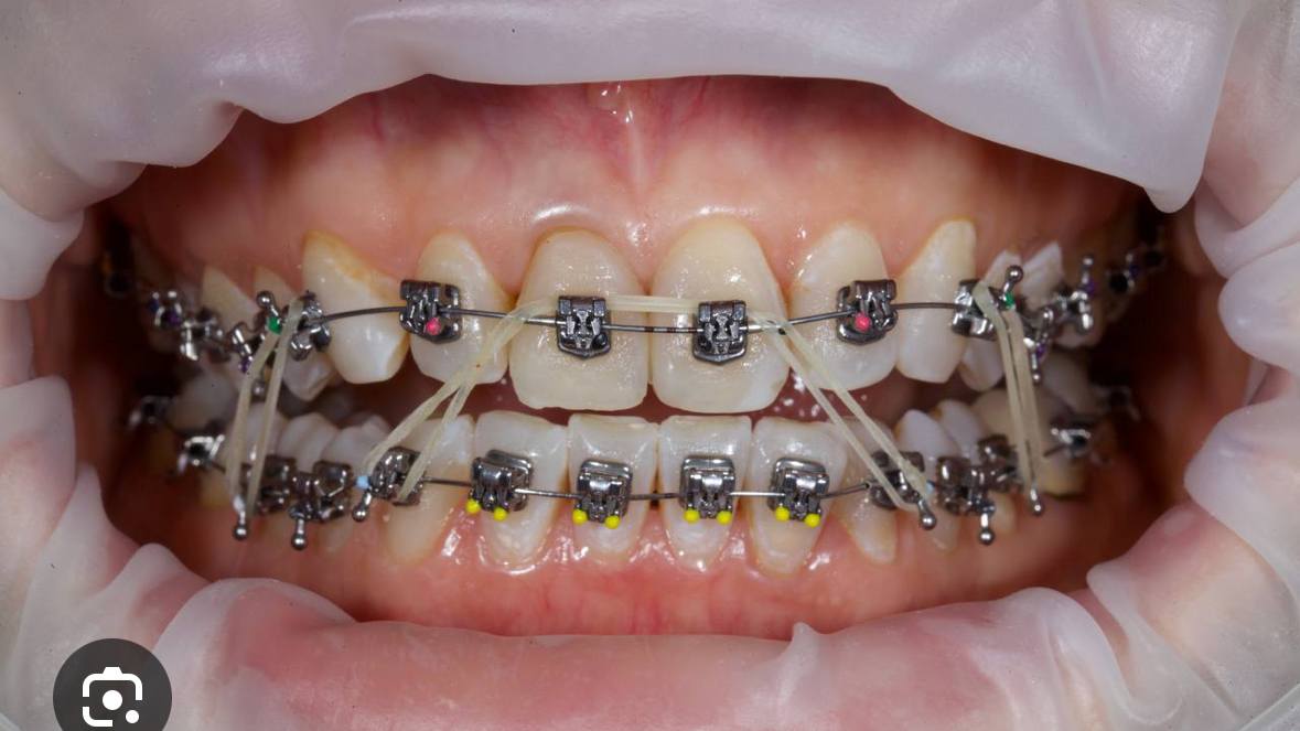 ПРОШУ ПОМОЩИ Хочу поставить брекеты