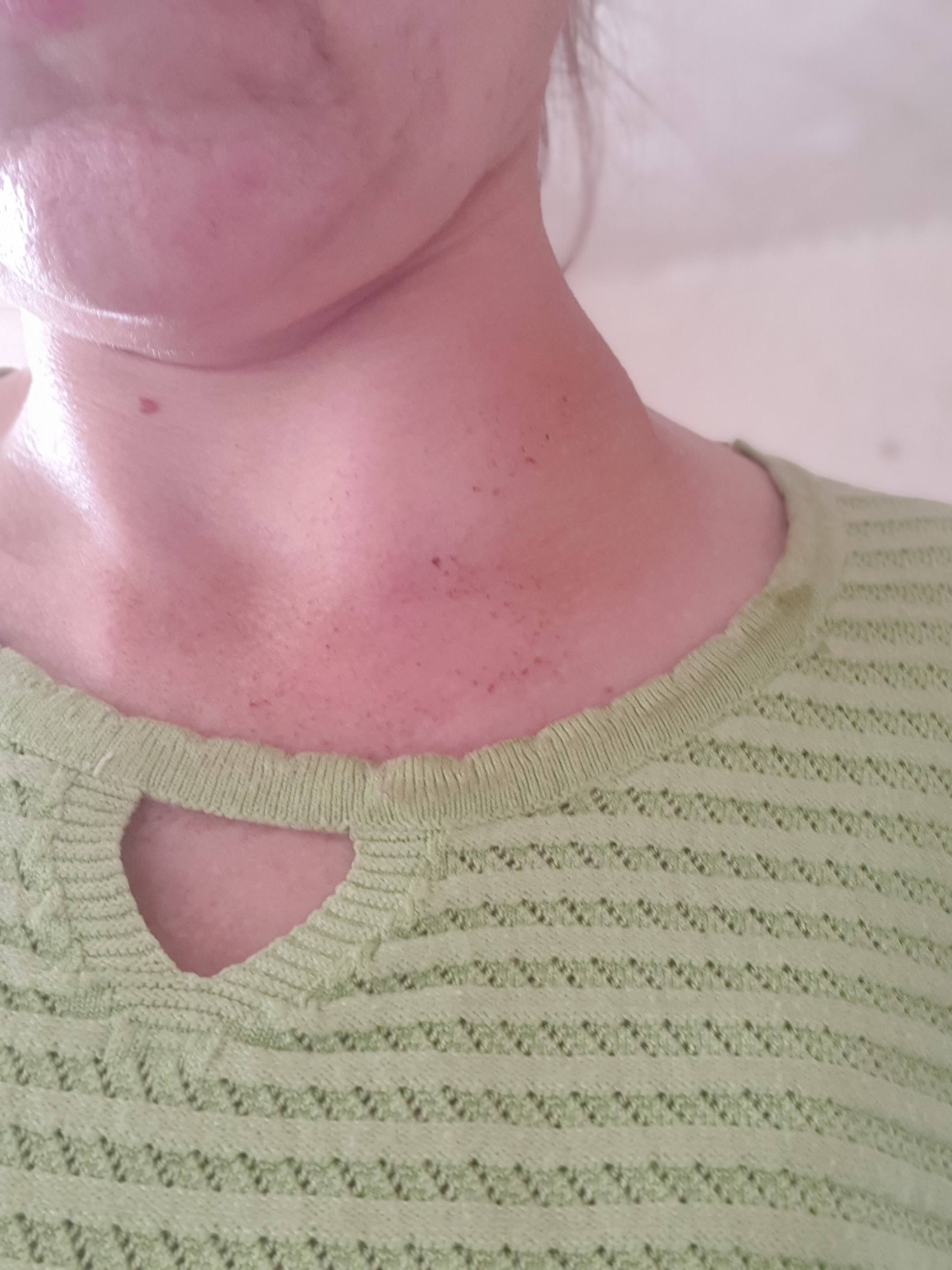 Нужны деньги на лечение,у меня рак щж