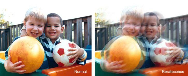 Нужны деньги на пересадку роговицы