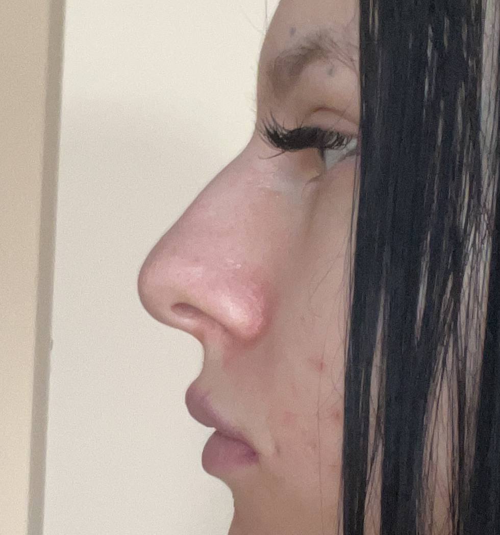 Мечтаю о ринопластике