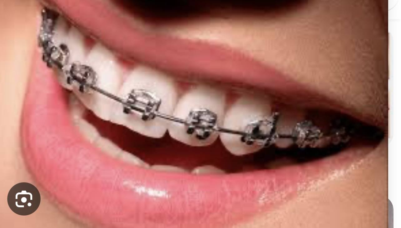 Мечтаю о красивых и ровных зубах