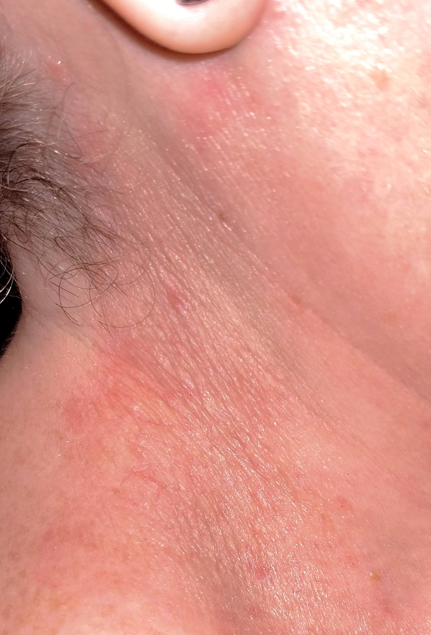 Мазь от дерматита