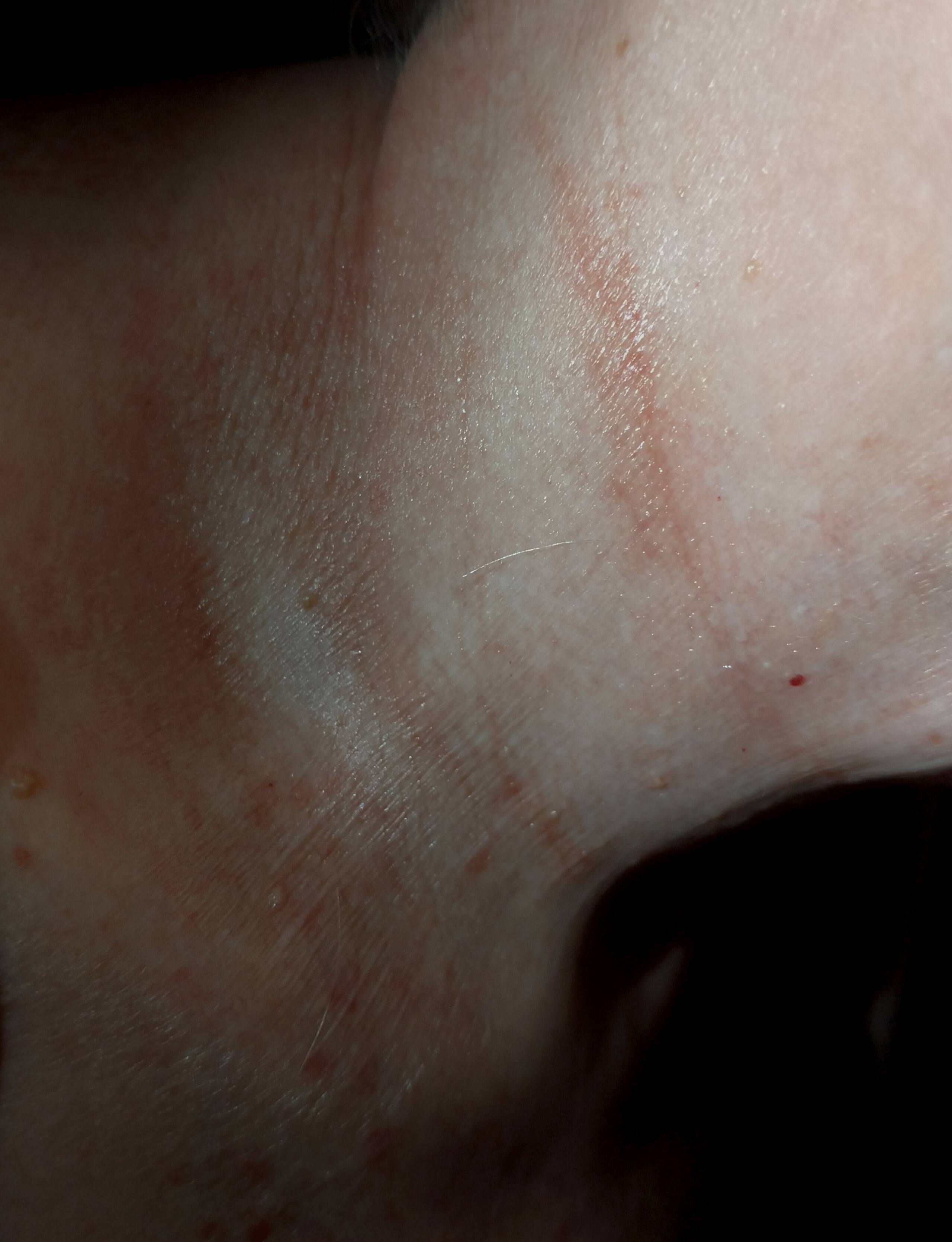 Мазь не помогла