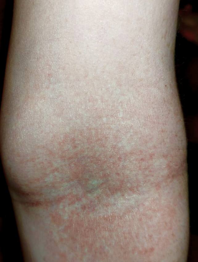 Срочно на дерматолога