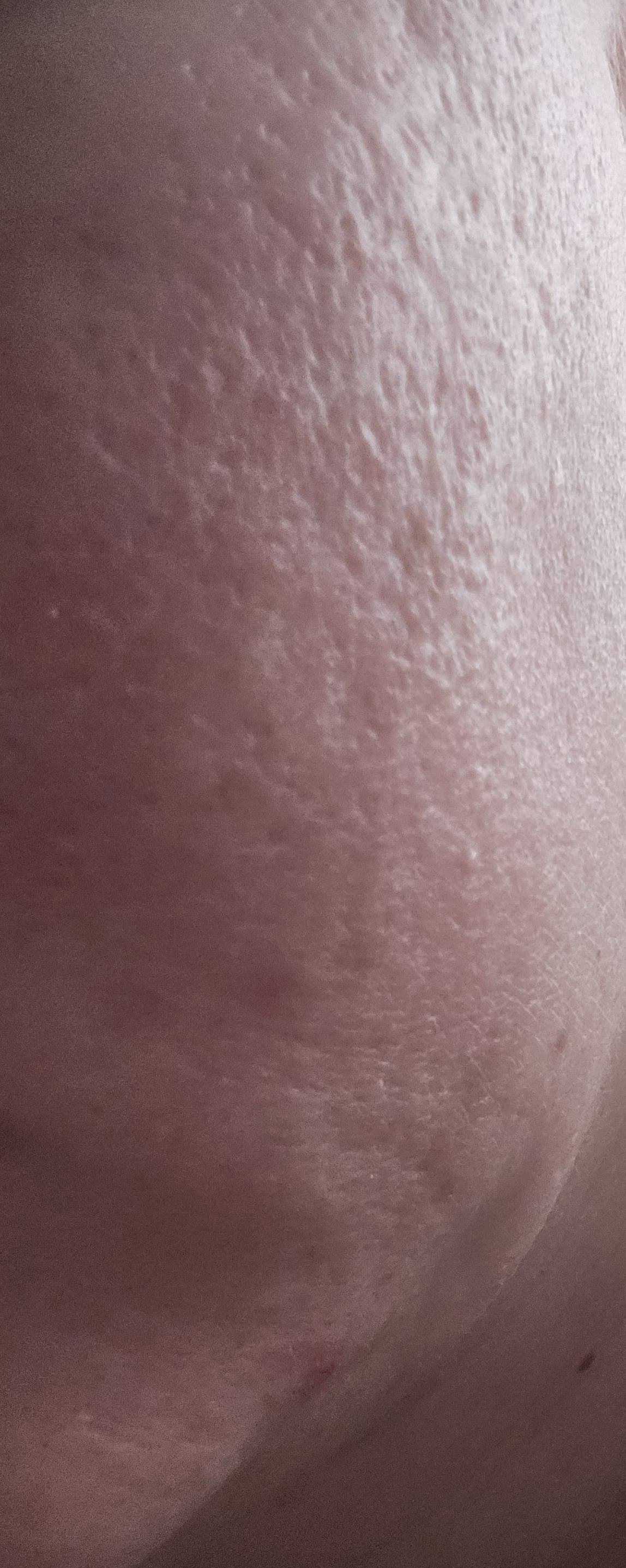 Помогите избавиться от рубцов на лице