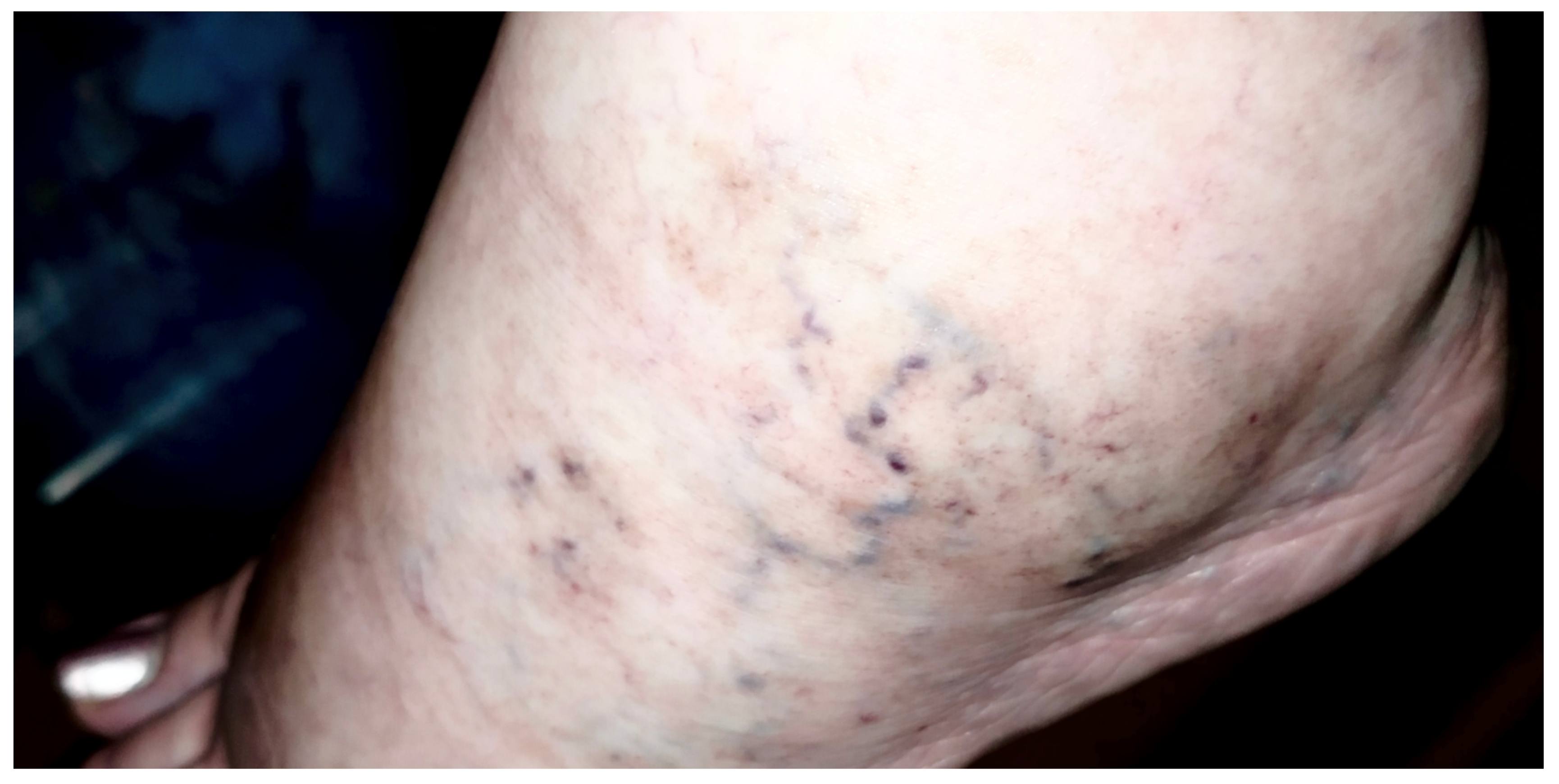 Нужно срочно к флебологу