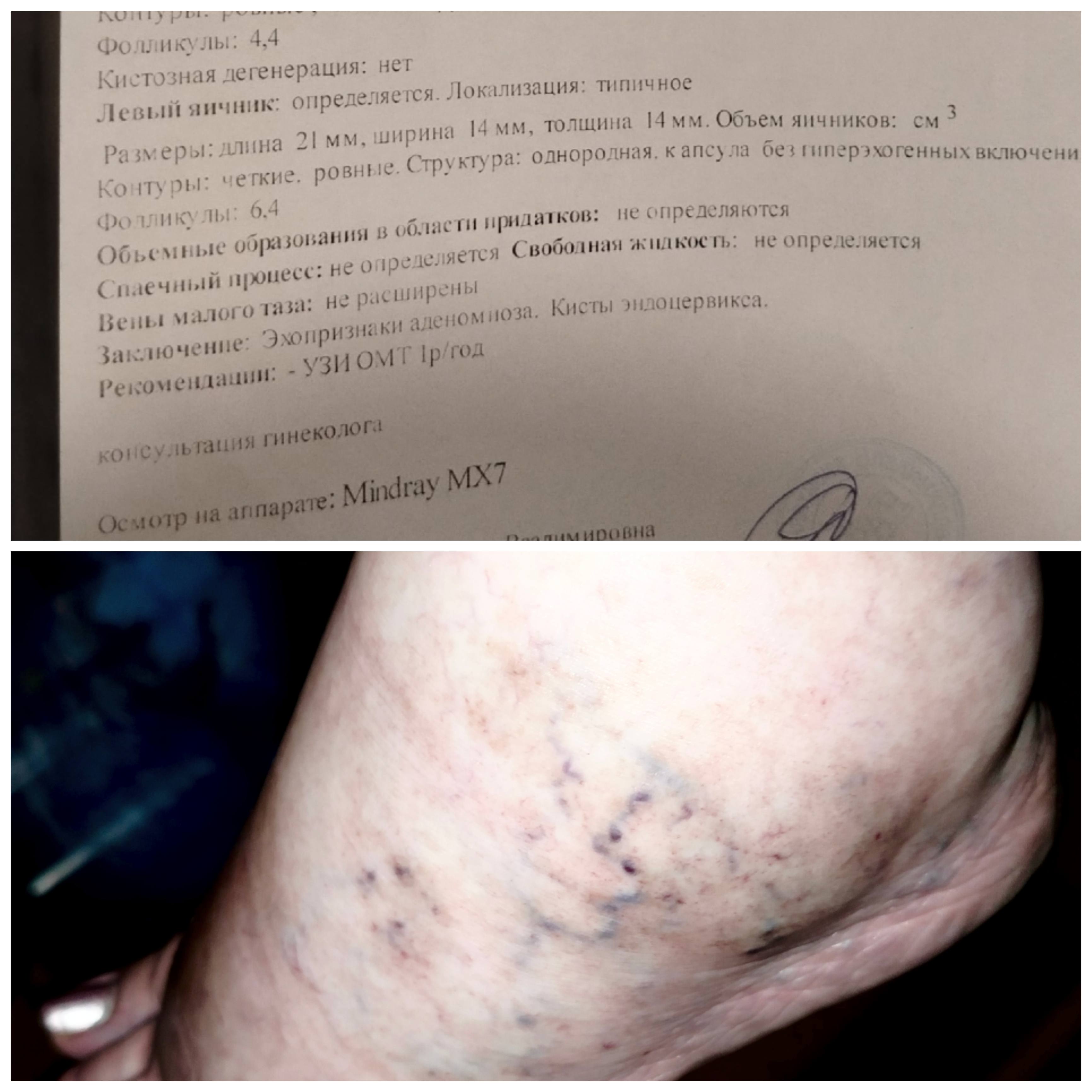 Срочно к флебологу, ужасно отекли ноги