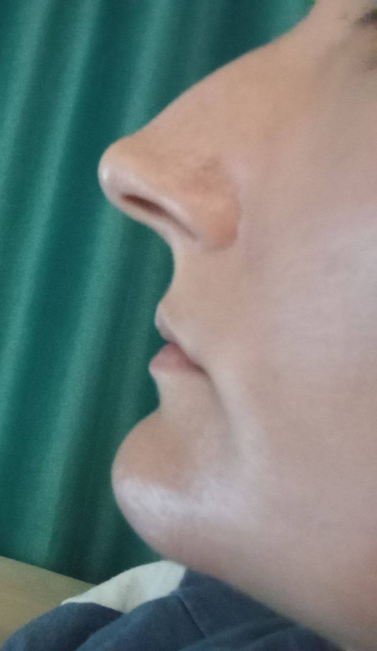 Мечтаю о ринопластике